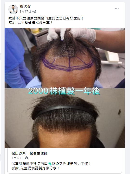 植髮,楊名權,生髮613,ARTAS,禿頭